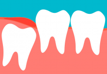 Зубы «мудрости»: удалять или лечить
