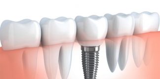 Как подготовиться к операции по установке имплантатов: советы от эксперта. Часть 2