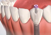 Как подготовиться к операции по установке зубных имплантатов: советы от эксперта зубные импланты