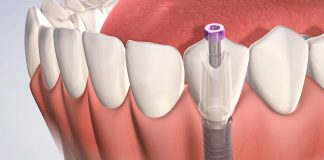 Как подготовиться к операции по установке зубных имплантатов: советы от эксперта зубные импланты