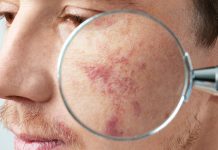 Победа над солнцем: боремся с пигментацией Пигментация - Каменный лес Stone Forest