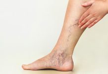 Консультация у флеболога: ответы на популярные вопросы Консультация у флеболога