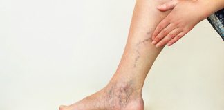 Консультация у флеболога: ответы на популярные вопросы Консультация у флеболога