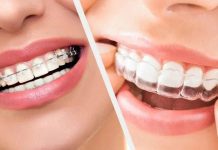 Брекеты или элайнеры – что рекомендуют ортодонты Брекеты или элайнеры