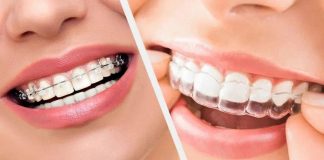 Брекеты или элайнеры – что рекомендуют ортодонты Брекеты или элайнеры