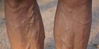 Топ-5 мифов о варикозе Мифы о варикозе