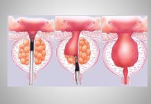 Шаг за шагом: процесс операции ТУР простаты ТУР простаты