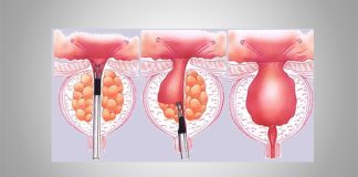 Шаг за шагом: процесс операции ТУР простаты ТУР простаты