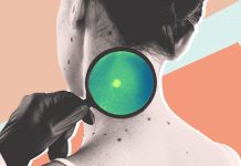 Удаление невусов (родинок): Какие способы наиболее безопасны и эффективны? Удаление невусов