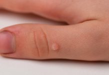 Лазер против бородавок: современные методы удаления и что выбрать Лазер против бородавок