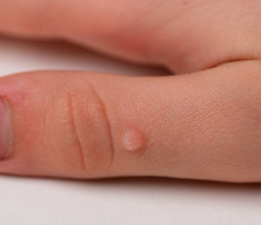 Лазер против бородавок: современные методы удаления и что выбрать Лазер против бородавок