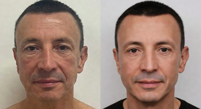 muzhskaja-plastika-0 Почему мужчины стали чаще обращаться к пластическим хирургам