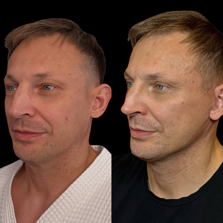 Почему мужчины стали чаще обращаться к пластическим хирургам